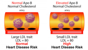 ldl-particle-size-and-heart-risk-300x171